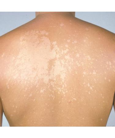 Naturasil Tinea Versicolor Topical Treatment 15mL - Eliminate Candida & Onychomycosis - Buy Online on GoSupps.com