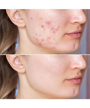 Melasma Treatment Face Toner - Korean Skincare | Brightening & Soothing | 155ml - Buy Online on GoSupps.com