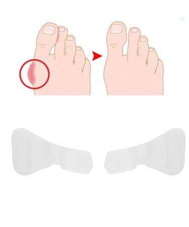 Hallux Valgus Toe Spreader Set - 5 Pairs Silicone Separator Tools for Overlapping & Hammer Toes - Pain Relief & Correction - Buy Online on GoSupps.com