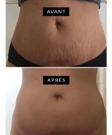  G n rique Super Effective Stretch Mark Peel Black Soap 100g - Buy Online on GoSupps.com