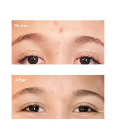 Perricone MD Acne Relief Prebiotic Acne Therapy 30 Day Regimen - Buy Online on GoSupps.com