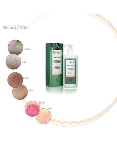 Moraz Hand Cream and Skin Rash Cream - Soothe, Hydrate & Nourish | Reduce Symptoms of Skin Rashes | Ultimate Skin Care Pack - Buy Online on GoSupps.com