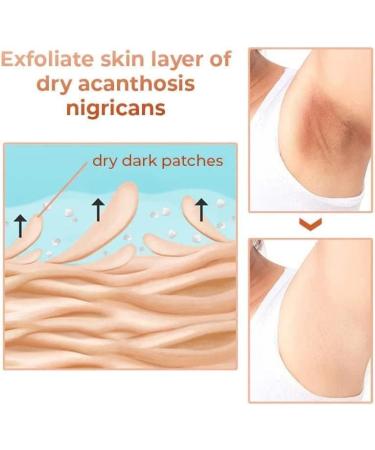 Acanthosis Nigricans Huile de th rapie pour corriger les taches sombres traitement de l'acanthose nigricans limine les taches sombres pour claircir le corps et la peau noire (1 pi ce) 1 pi ce. - Buy Online on GoSupps.com