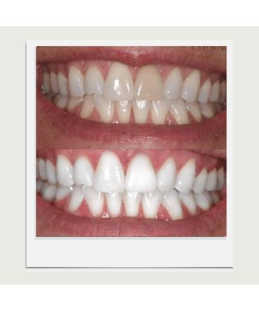 Expertwhite Pro-Grade Teeth Whitening Kit | 35% Carbamide Peroxide Whitener with 32 XLED Lights | Erase Stains Fast! - 12 Treatments - Buy Online on GoSupps.com