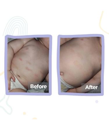 Unisex Baby Long Sleeve Bodysuit: Soothes Eczema, Moisturizes Dry Skin, Reduces Itching | Skincare Clothing with Foldable Mittens 12-18 - Buy Online on GoSupps.com