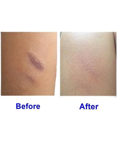 Buy Hirudoid Cream 20g - Advanced Scar Treatment | International Shipping Available - Buy Online on GoSupps.com