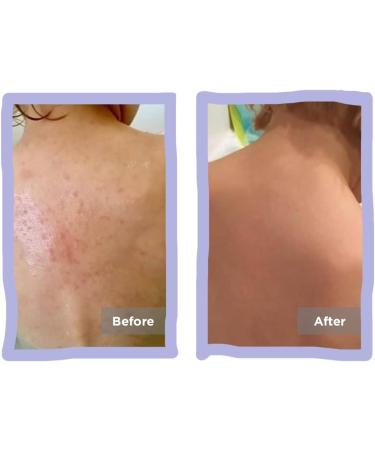 Eczema Baby Sleepsuit | Moisturizing, Itch-Reducing Clothing for Dry Skin | Long Sleeve with Built-In Mitts | 18-24 Months White - Buy Online on GoSupps.com