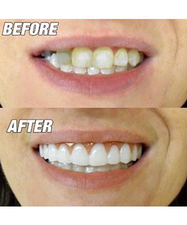 Instant Smile Flex 2 pack plus 2 beads- BRIGHT WHITE SHADE - One Size Fits Most - Buy Online on GoSupps.com