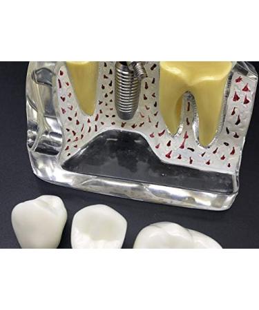 4x Enlarged Teeth Model for Dental Education | Implant & Crown Simulation | Ideal for Teaching & Demonstration - Buy Online on GoSupps.com