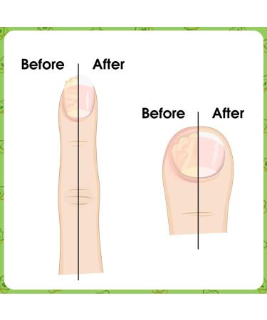 VYTALIVING BioClear Nail Doctor - Ingrown Toenail Treatment - Fungal Nail Treatment for Toenail Aids in Toe Nail Care | 15 ml - Buy Online on GoSupps.com