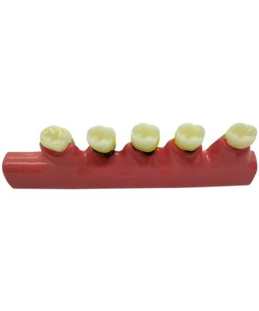 Dytah Dental Model - Adult Teeth Lessons for Periodontitis & Dental Disease Classification | Ideal for Teaching & Study - Buy Online on GoSupps.com