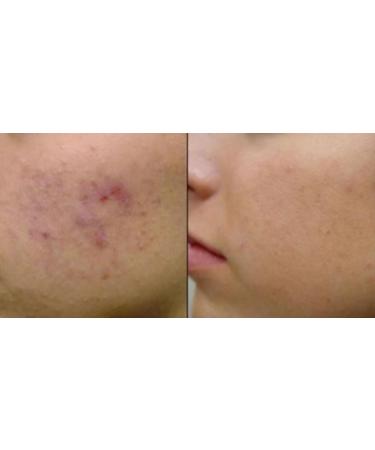 Effective Skin Care Solutions: Cure Acne Psoriasis Sunspots & Scars Shop Internationally - Buy Online on GoSupps.com