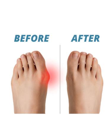 Healthguard Premium Bunion Corrector Socks - Bunion Relief Sleeve Splint for Big Toe - 3 Pairs Black Small - Buy Online on GoSupps.com