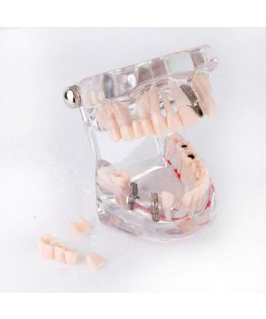 Cocoarm Removable Tooth Model - Dental Care Demo Tool for Teaching Study & Implant Education - Buy Online on GoSupps.com