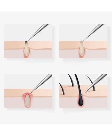 Pimple Extractor Tool 6X Stainless Steel Comedone Extractor Tools Facial Blackhead Remover Tweezers With Case For Face & Nose - Buy Online on GoSupps.com