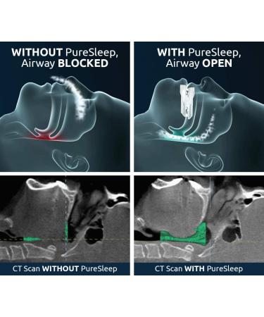 PureSleep Anti-Snoring Mouthpiece - Stop Snoring with the Original, Comfortable & Adjustable Solution - Over 1 Million Sold - Made in USA - Buy Online on GoSupps.com