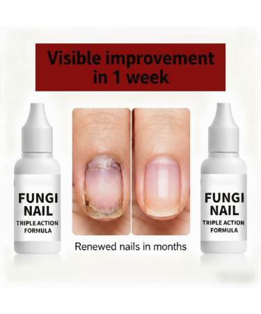 Toenail Fungus Treatment Overnight Long Lasting Nail Treatment for Athletes Foot Thick Broken Discolored and Damaged Nails 15 Ml05 Oz 1 pcs - Buy Online on GoSupps.com