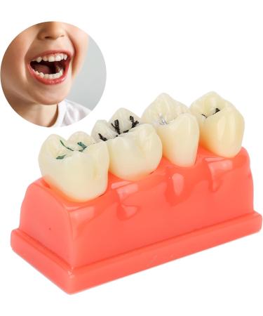 Ververt Touch Tooth Model - 180mm Dental Caries Demonstration Model for Schools & Dentists | Learning Aid for Dental Lessons - Buy Online on GoSupps.com