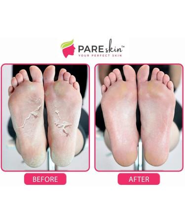  2 Pack Foot Peel Mask - Cracked Heels Repair for Dry Callus Dead Skin - Exfoliating Peel Remover for Baby Soft Feet - Buy Online on GoSupps.com