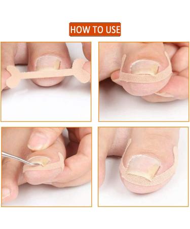40 PCS Ingrown Toenail Corrector Stickers Breathable Self-Adhesive Elastic Toenail Correction Patch for Toenail Treatment Fingernail Care Protect Toe Nail - Buy Online on GoSupps.com