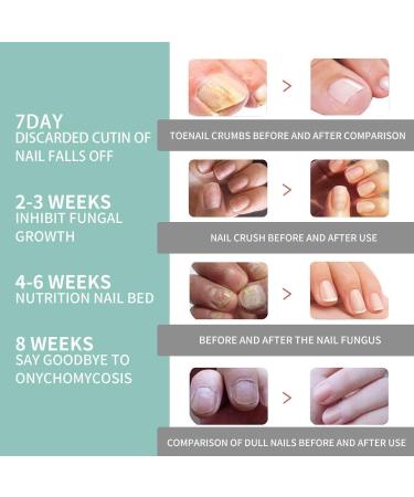 Nail Care Pen for Nail Fungus Treatment | Nourish Fingernails & Toenails with Aloe Vera Tea Tree Oil & Vitamin E | 3 Pieces - Austria - Buy Online on GoSupps.com