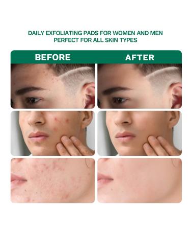 2% Salicylic Acid Acne Treatment Pads with Witch Hazel - 80 Count - Buy Online on GoSupps.com