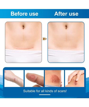 Scar Away Silicone Scar Sheets - 1.6 x 60 Roll - Surgical, C-Section, Keloid, Tummy Tuck, Burn, Stretch Marks - Reusable Scar Removal Strips - Buy Online on GoSupps.com