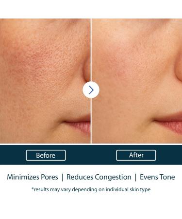 NAELI AHA/BHA Exfoliating Face Wash - 10% Glycolic Acid & Salicylic Acid Cleanser Anti Aging Acne & Wrinkle Reducing Facial Exfoliant Pore Minimizer & Brightening Gel 6 oz 6 Fl Oz (Pack of 1) - Buy Online on GoSupps.com