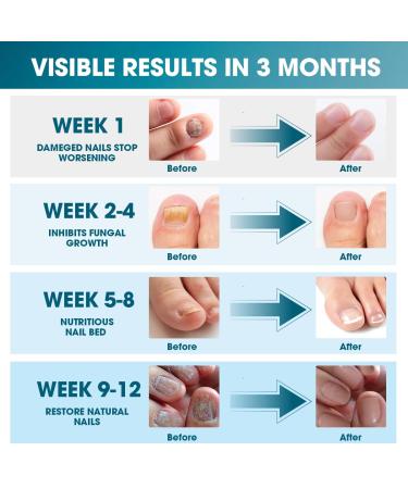 Nail Fungus Light Device - 905nm Infrared & 470nm Blue Light for Toenail & Fingernail Repair | Effective Solution for Damaged & Discolored Nails - Buy Online on GoSupps.com