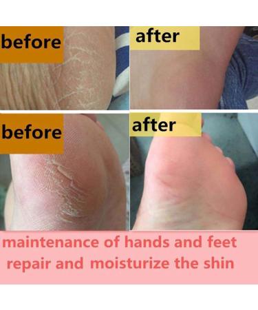 Lintat Hand & Foot Crack Cream | Natural Moisturizer for Dry Skin Heels & Chapped Skin | Anti-Dry Ointment for Int'l Shipping - Buy Online on GoSupps.com