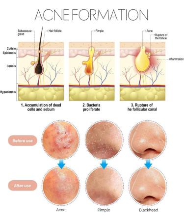 Teenitor 7 in 1 Pimple Blackhead Remover Extractor Tool Kit - Professional Acne Treatment for Nose and Face Skin - Buy Online on GoSupps.com