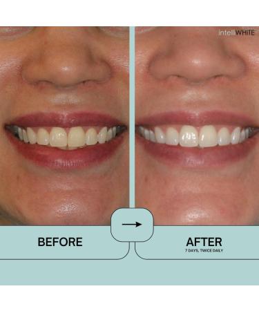 Buy Prostrips: 12 Shades Whiter Teeth - Enamel Safe Remineralizing Strips with 97% No Sensitivity - Fast International Shipping - Buy Online on GoSupps.com