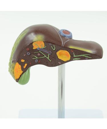 Liver Pathology Model Fatty Cirrhosis Carcinoma Demonstration Model Shows 7 Liver Diseases Detachable 2 Parts for Doctors Office Educational Tool - Buy Online on GoSupps.com