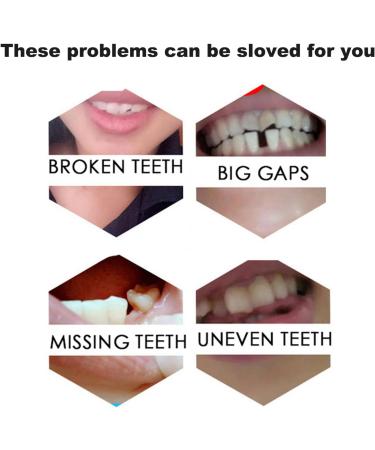 Instant Snap-On Veneers Tooth Repair Kit for Irregular or Missing Teeth - Smile Adhesive Included - Buy Online on GoSupps.com