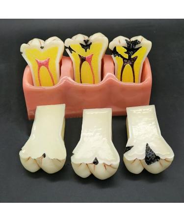 Samnuerly 4-fold dental teeth caries model removable caries evolutionary display tools for dental training materials tooth pathology display