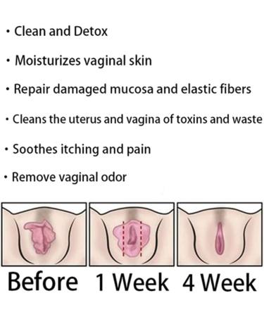 HENGBANG AnnieCare Instant Anti-Itch Detox Slimming Capsules - Firming and Repair for Clear, Fresh Skin (28 Capsules) - Buy Online on GoSupps.com