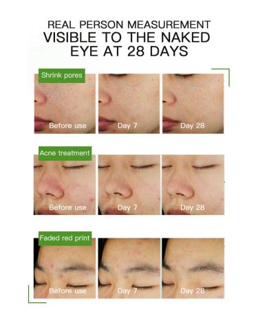 Azelaic Acid Face Cream for Acne Brightening & Skin Tone Correction | Oil Control Paraben-Free Cruelty-Free - Buy Online on GoSupps.com