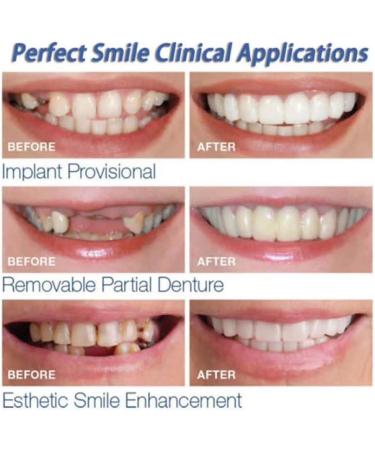 Provisional Dentures Instant Perfect Smile Flex Teeth Veneers | Cosmetic Dentistry Snap-On Comfort Fit | Universal Size - Buy Online on GoSupps.com