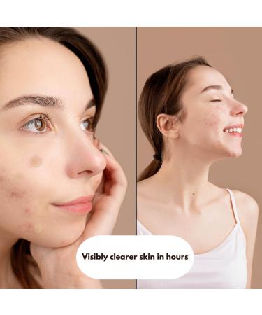 Shuvi Hydrocolloid Acne Blemish Patch - Vegan Cruelty-Free Treatment for Zits & Blemishes | 36 Count - All-Day/All-Night Adhesion - Buy Online on GoSupps.com