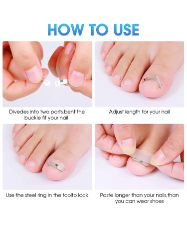 Ingrown Toenail Tools Set - 58 Pieces for Correction, Treatment, and Relief | Toe Nail Correction Buckle, File, Cuticle Pusher, Patch Tape, Finger Holster | Professional Ingrown Toenail Solution - Buy Online on GoSupps.com