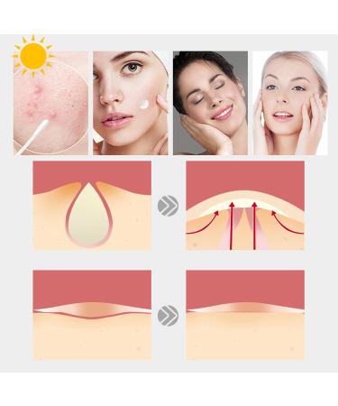 LacyMC Acne Patches - 60 Pack, 8mm & 12mm Hydrocolloid Dressing for Spots & Pimples - Buy Online on GoSupps.com