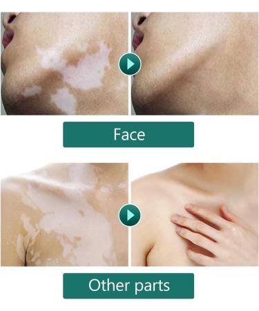  Fyearfly Vitiligo Cover Liquid Vitiligo Covering Liquid Waterproof Makeup Vitiligo Concealer Cosmetics For Face Body 20 ml - Buy Online on GoSupps.com