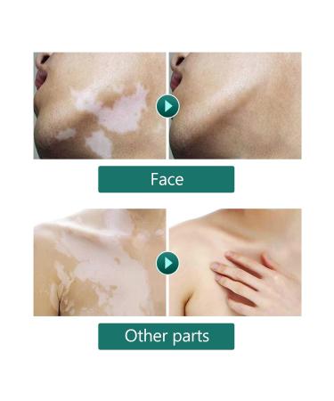 Vitiligo Cover Fluid for All Skin Tones - Waterproof Concealer Makeup 20ml for Men & Women - Buy Online on GoSupps.com