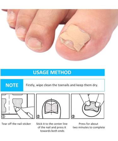 Toenail Patch Ingrown Toenail Toenail Correction Toenail Correction Patch Toenail Correction Patch Ingrown Toenail Nail Care 50 Pieces - Buy Online on GoSupps.com