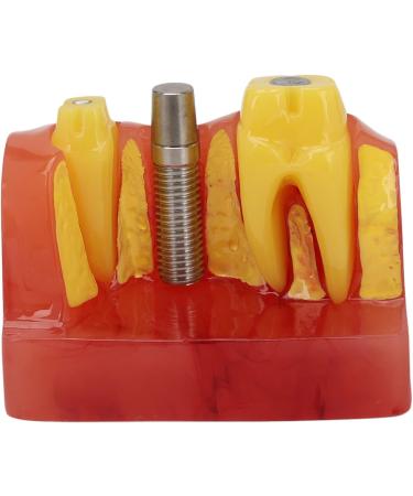 Dental Implant Model - 4x Enlargement Crown Bridge Demo Model for Recovery Effect Comparison | International Shipping Available - Buy Online on GoSupps.com