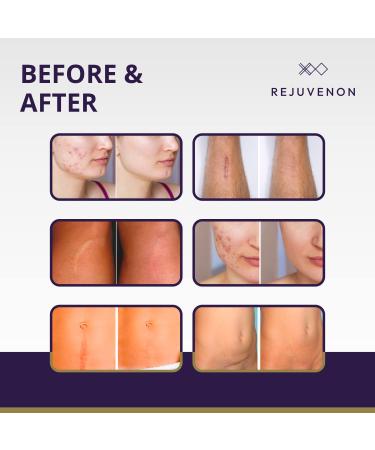 REJUVENON Silicone Scar Sheets - 6 Count for Removal & Healing of C-Section, Surgical, Acne, Burns, Tummy Tuck, Keloid Scars - Buy Online on GoSupps.com