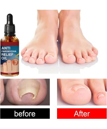 Ingrown Toenail Treatment Correction Drops Nail Growth Treatment Nail Care Ingrowing Toenail Treatment Ingrown Toenail Corrector Treatment for Ingrown Toenail Ingrowing Toenail Improve Toenail Health - Buy Online on GoSupps.com