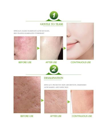 AICHUN BEAUTY Acne Cleaning Cream - 30ml Pimple & Comedone Repair | Skin Care for Clearer Skin - International Shipping Available - Buy Online on GoSupps.com