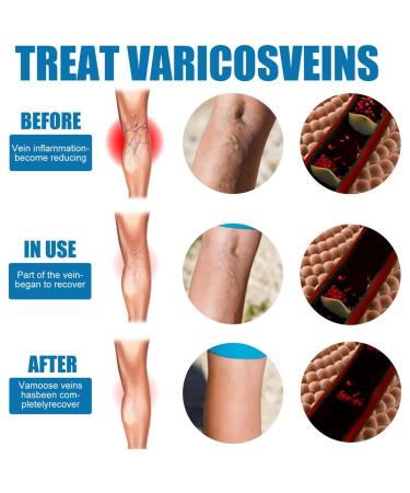Varicose Veins Cream - Lichengtai Miracle Spray for Varicose & Spider Veins Relief - 3 Pack (20g) - Fast Muscle Soreness Relief - Buy Online on GoSupps.com