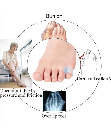 Jycch 10-Piece Pinky Toe Splint & Gel Toe Separators - Hammer Toe Straightener for Men & Women | Relief for Walking Running & Overlapping Toes - Buy Online on GoSupps.com